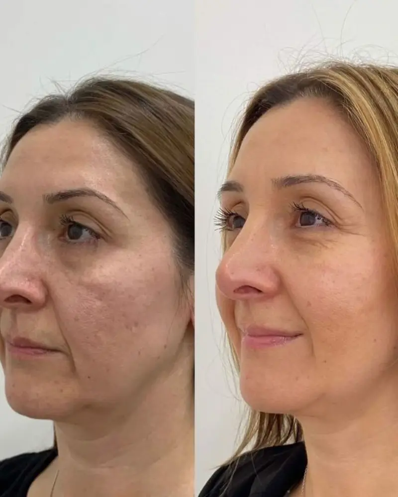 Result from a professional using the method