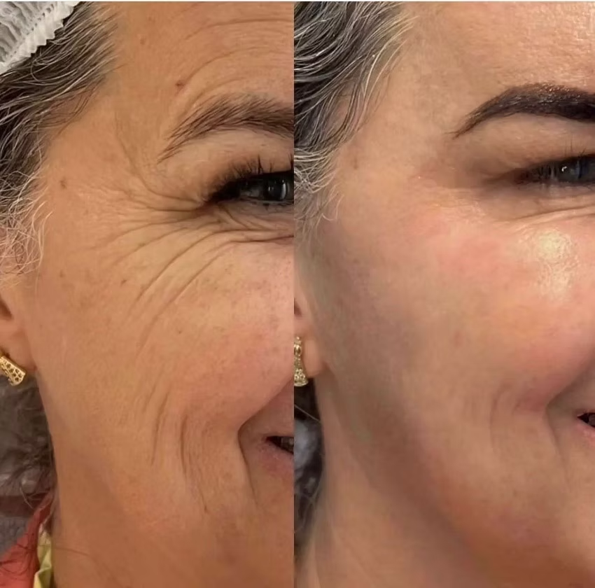 Result from a professional using the method