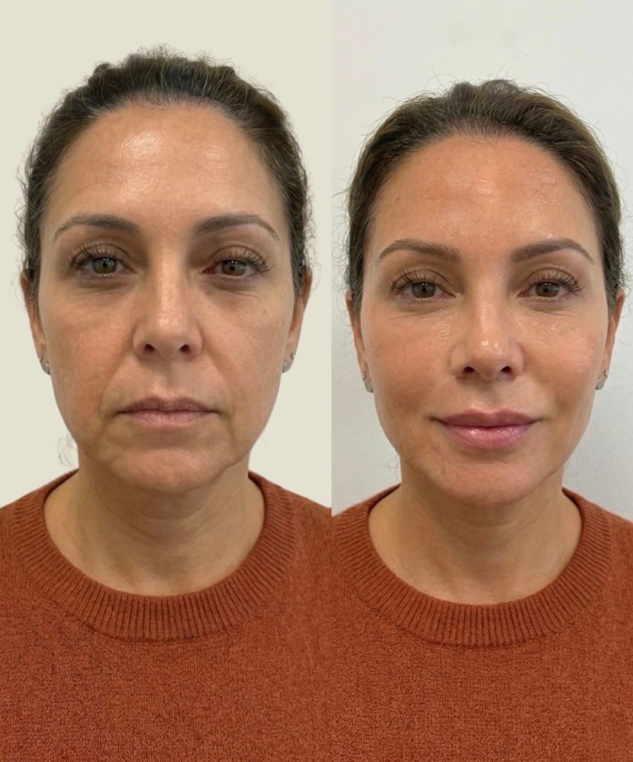 Result from a professional using the method