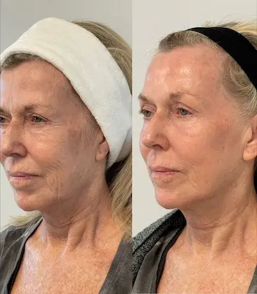 Result from a professional using the method